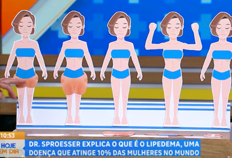 Você sabe o que é lipedema?