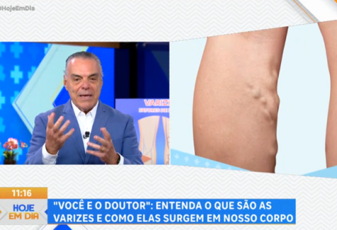 Saiba como prevenir e tratar varizes