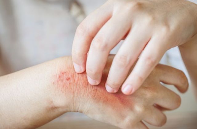 Alergia ao suor, o que fazer? 
